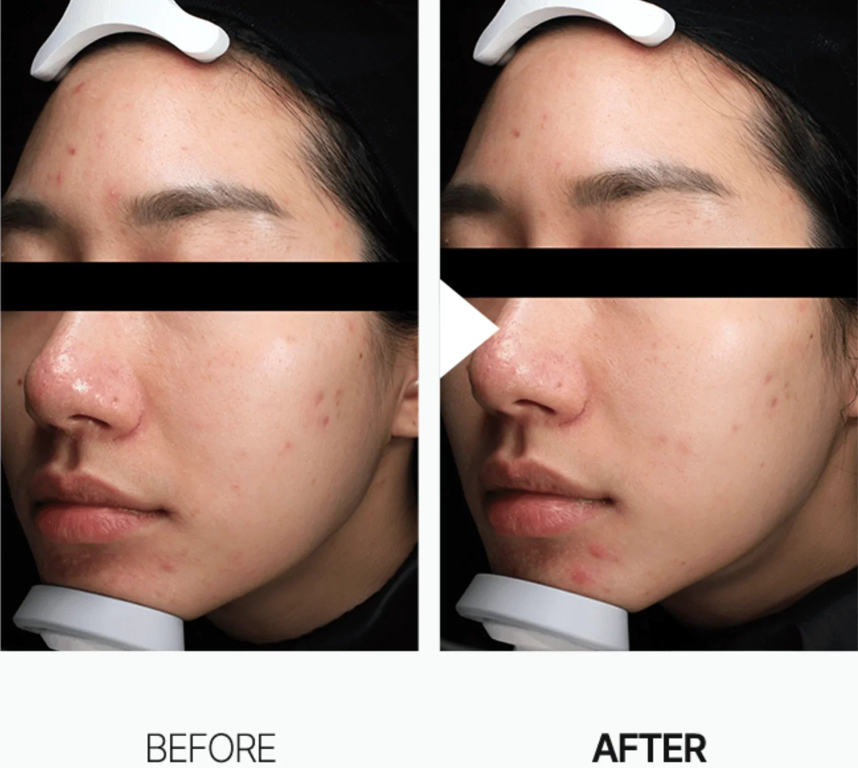 ANUA | Tónico. Heartleaf 77 Soothing Toner - 250ml - Haru Skin Haru Skin