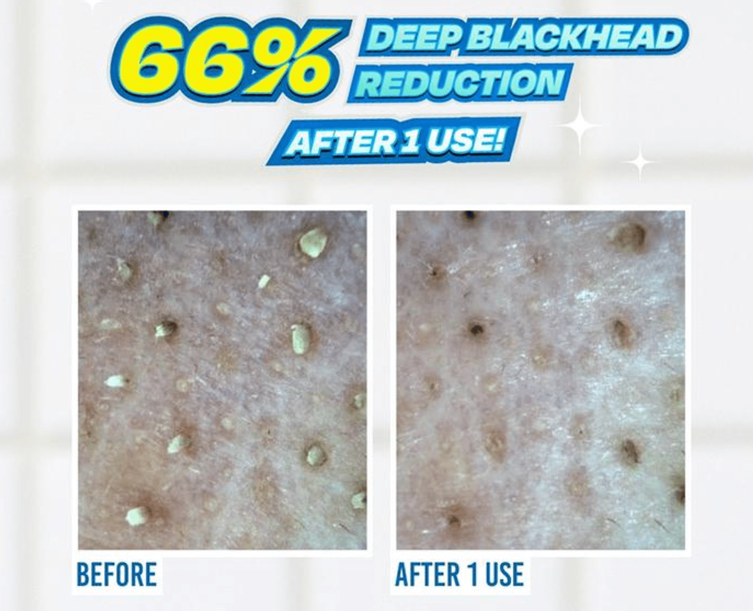 JUMISO | Exfoliante. Blackhead Melting Softner + Pads + Swabs – 150 ml - Haru Skin Haru Skin